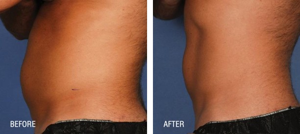 Liposonix before and after photos