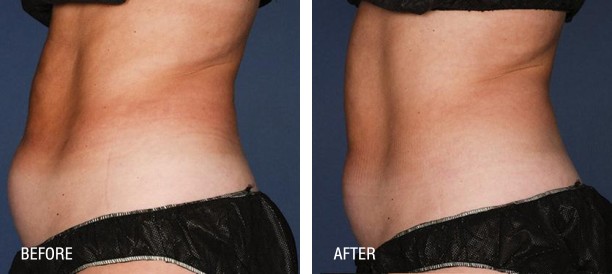 Liposonix before and after photos