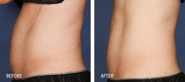 Liposonix before and after photos