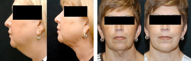 Smartlipo - Neck