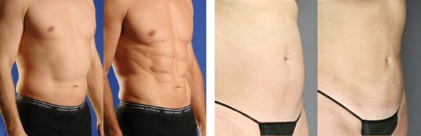 Smartlipo - Abdomen