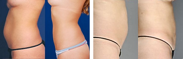 Smartlipo - Abdomen