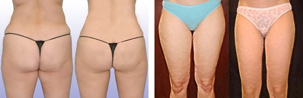 Smartlipo - Thighs